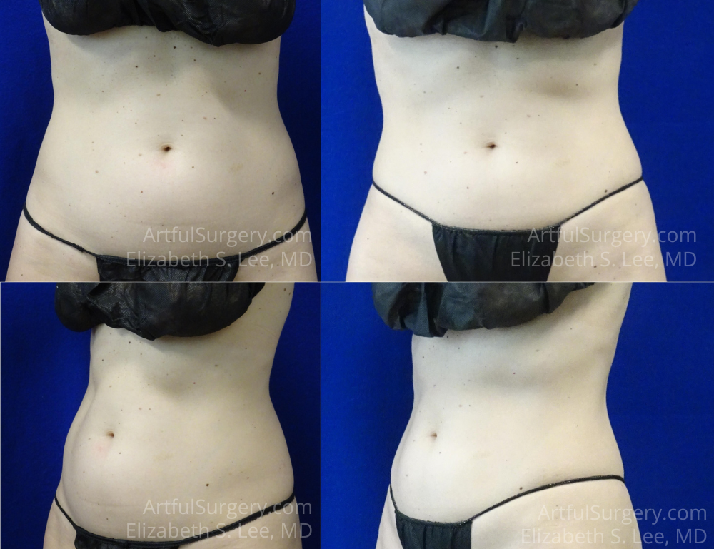 Picture of CoolSculpting-27