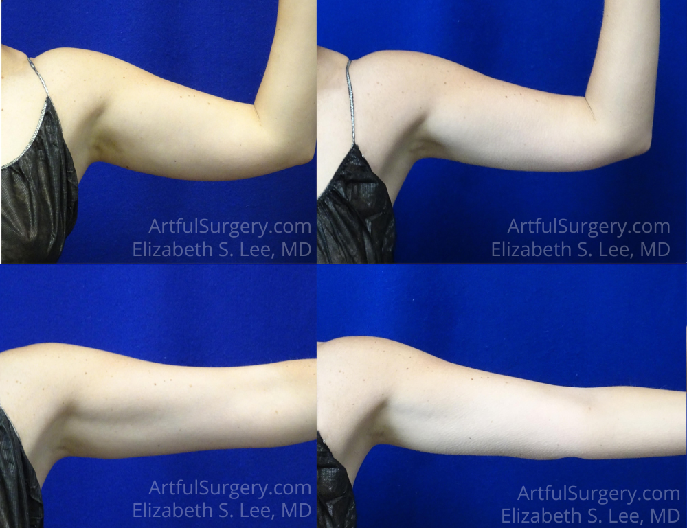 Picture of CoolSculpting-28