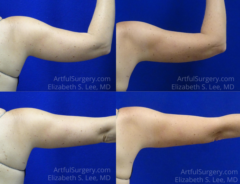 Picture of CoolSculpting-29