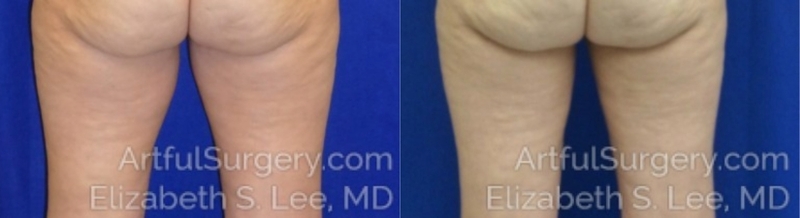 Picture of CoolSculpting-03