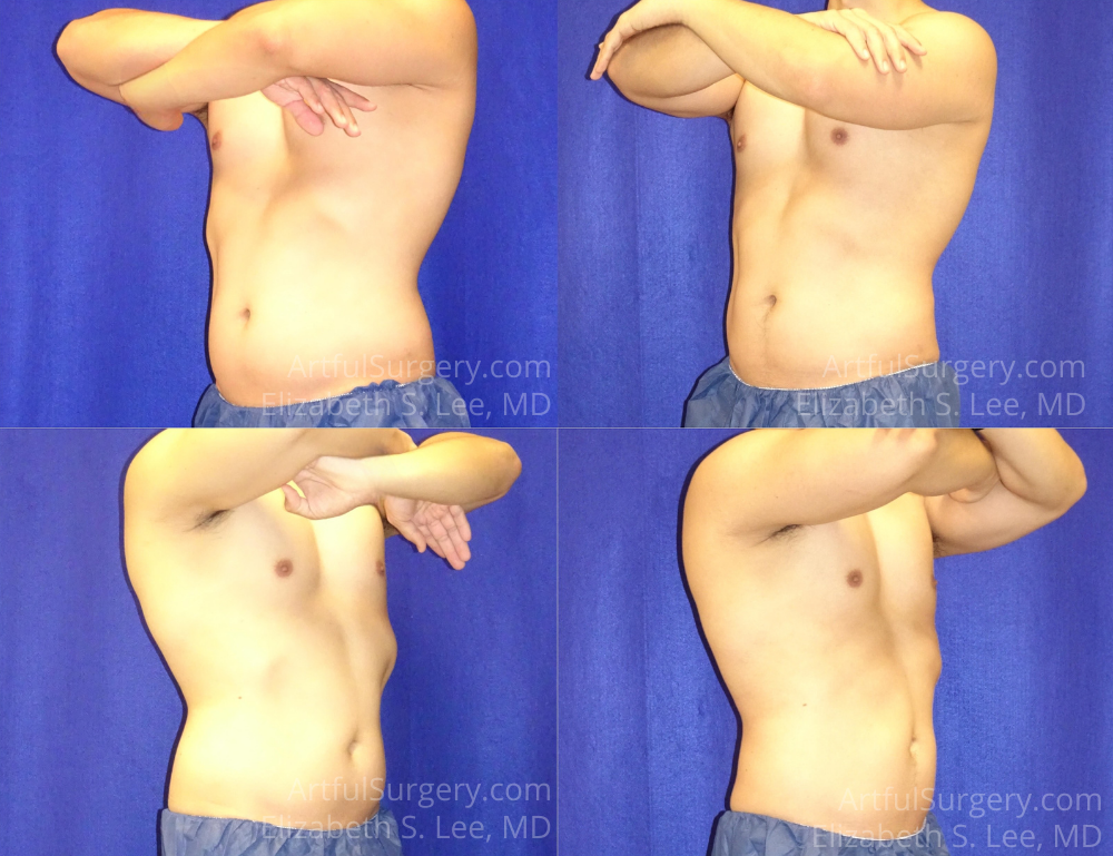 Picture of CoolSculpting-30