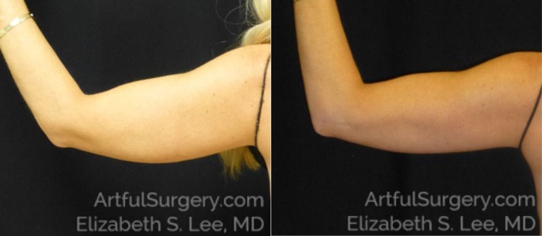 Picture of CoolSculpting-31