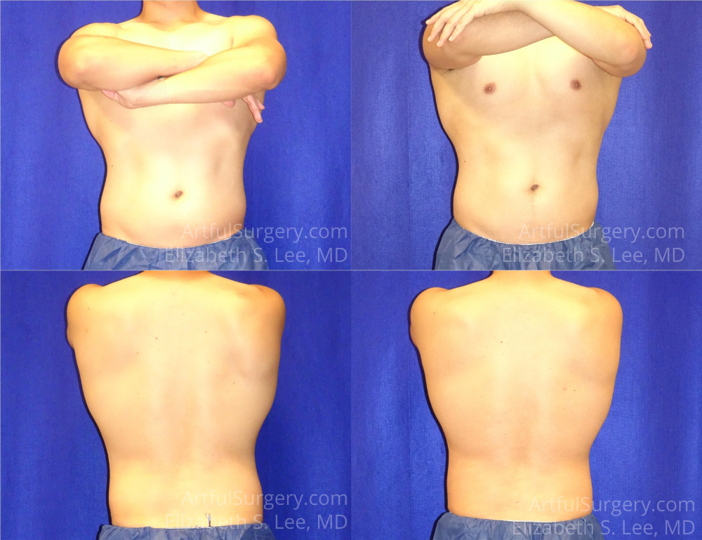 Picture of CoolSculpting-30