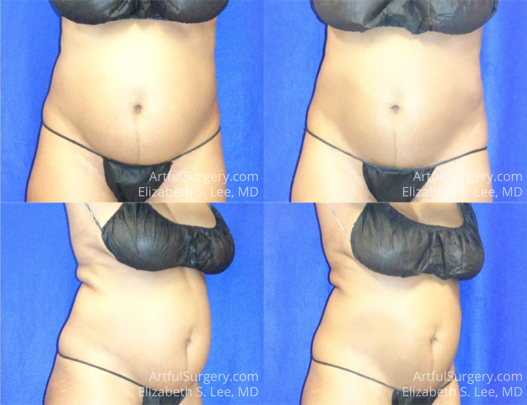 Picture of CoolSculpting-32