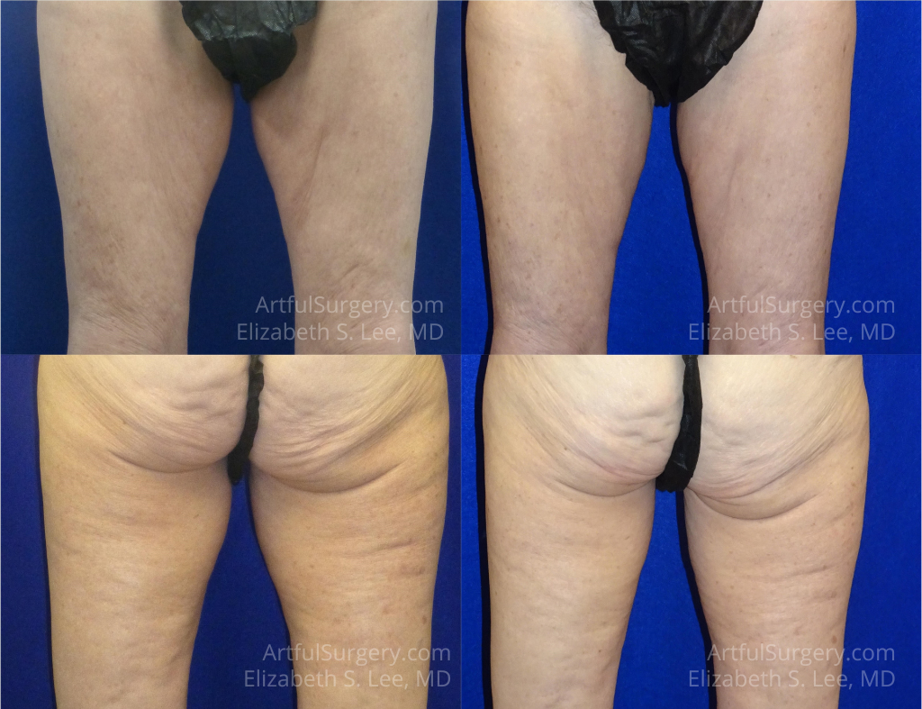 Picture of CoolSculpting-33