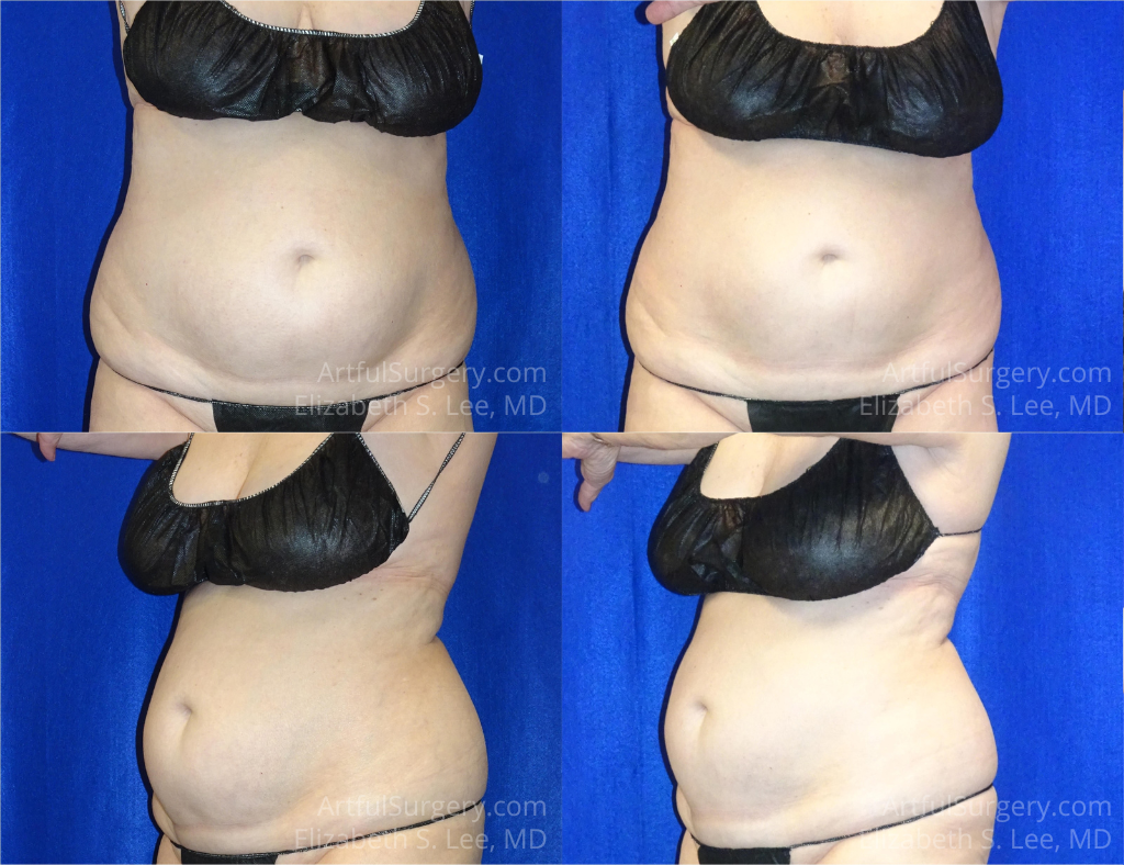 Picture of CoolSculpting-34