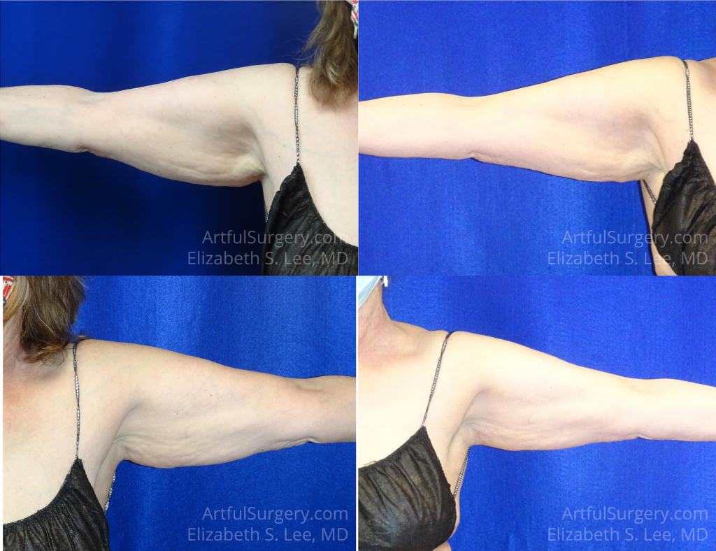 Picture of CoolSculpting-35