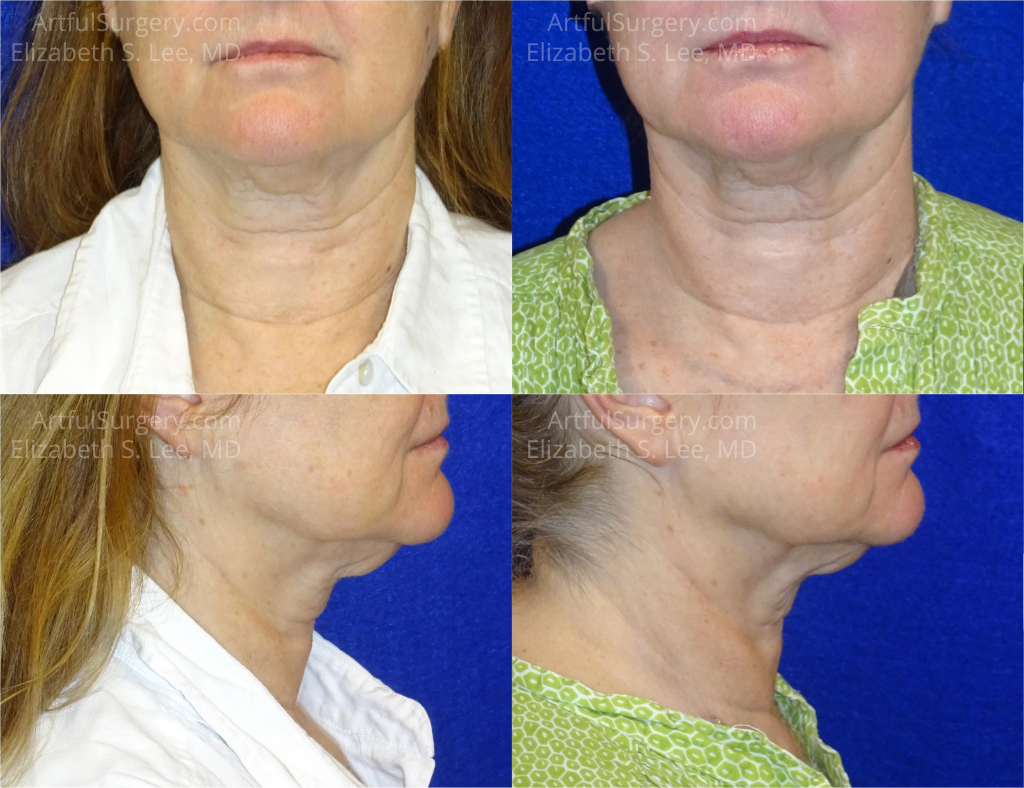 Picture of CoolSculpting-36