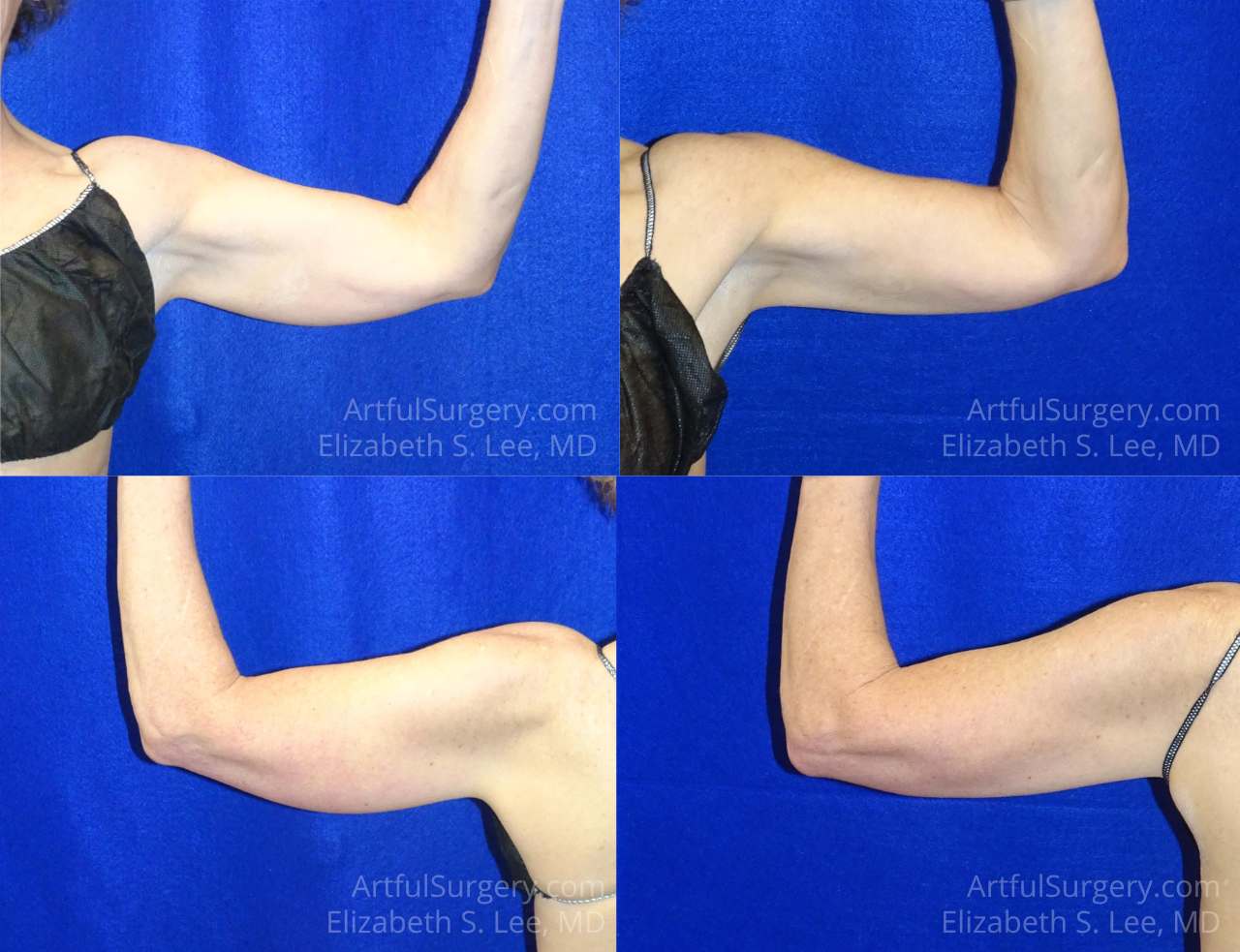 Picture of CoolSculpting-38