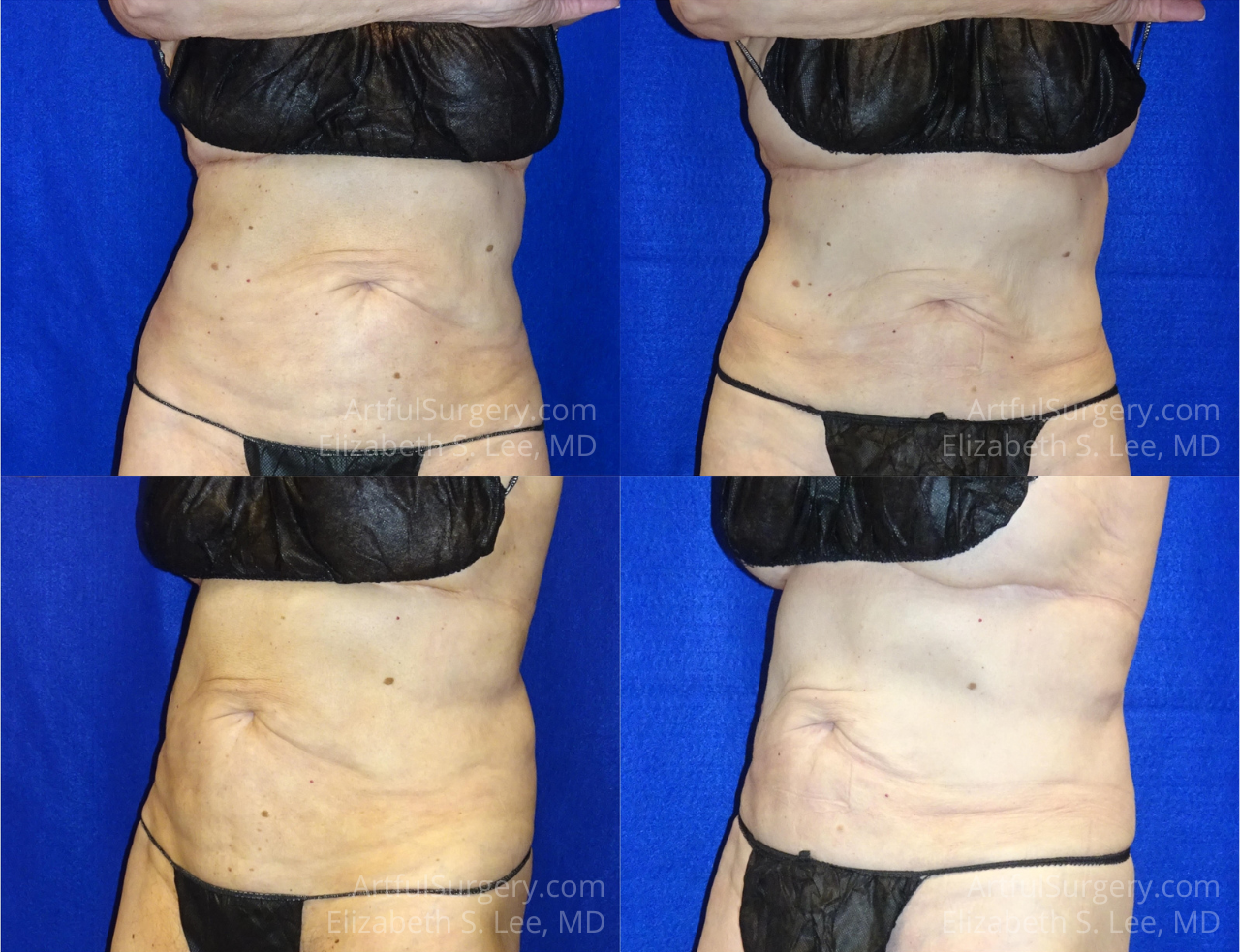 Picture of CoolSculpting-39