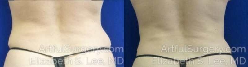 Picture of CoolSculpting-04