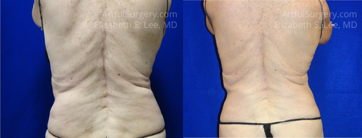 Picture of CoolSculpting-40
