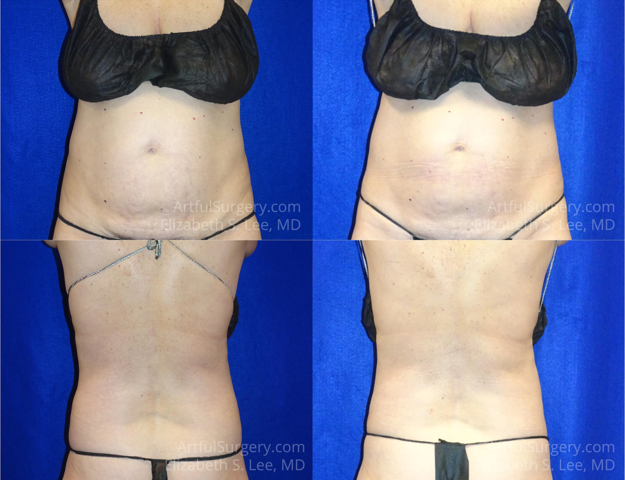 Picture of CoolSculpting-41