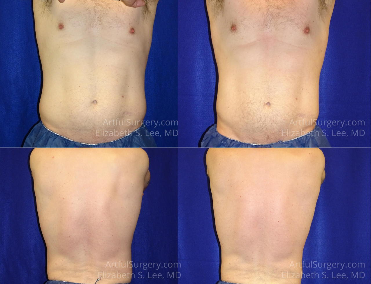 Picture of CoolSculpting-42