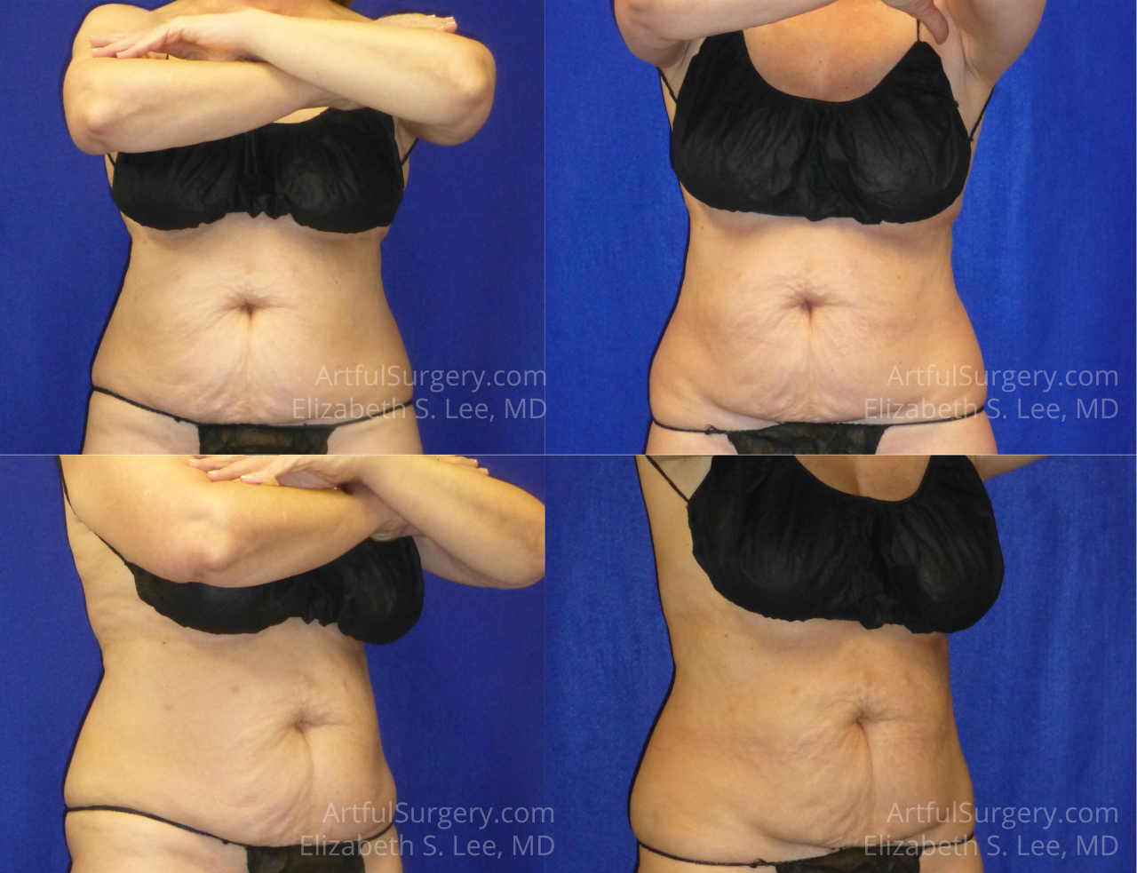 Picture of CoolSculpting-43