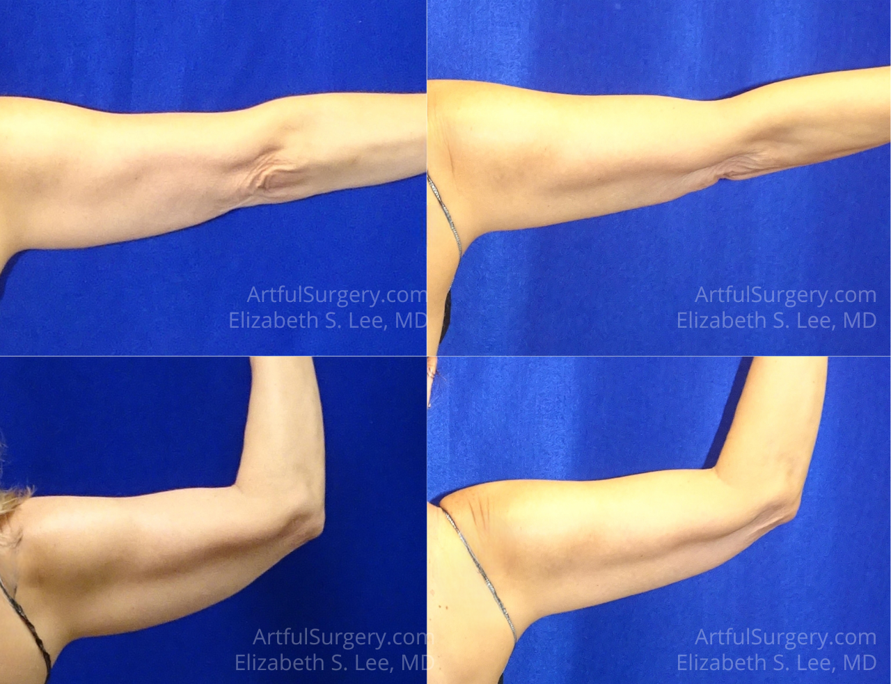 Picture of CoolSculpting-44