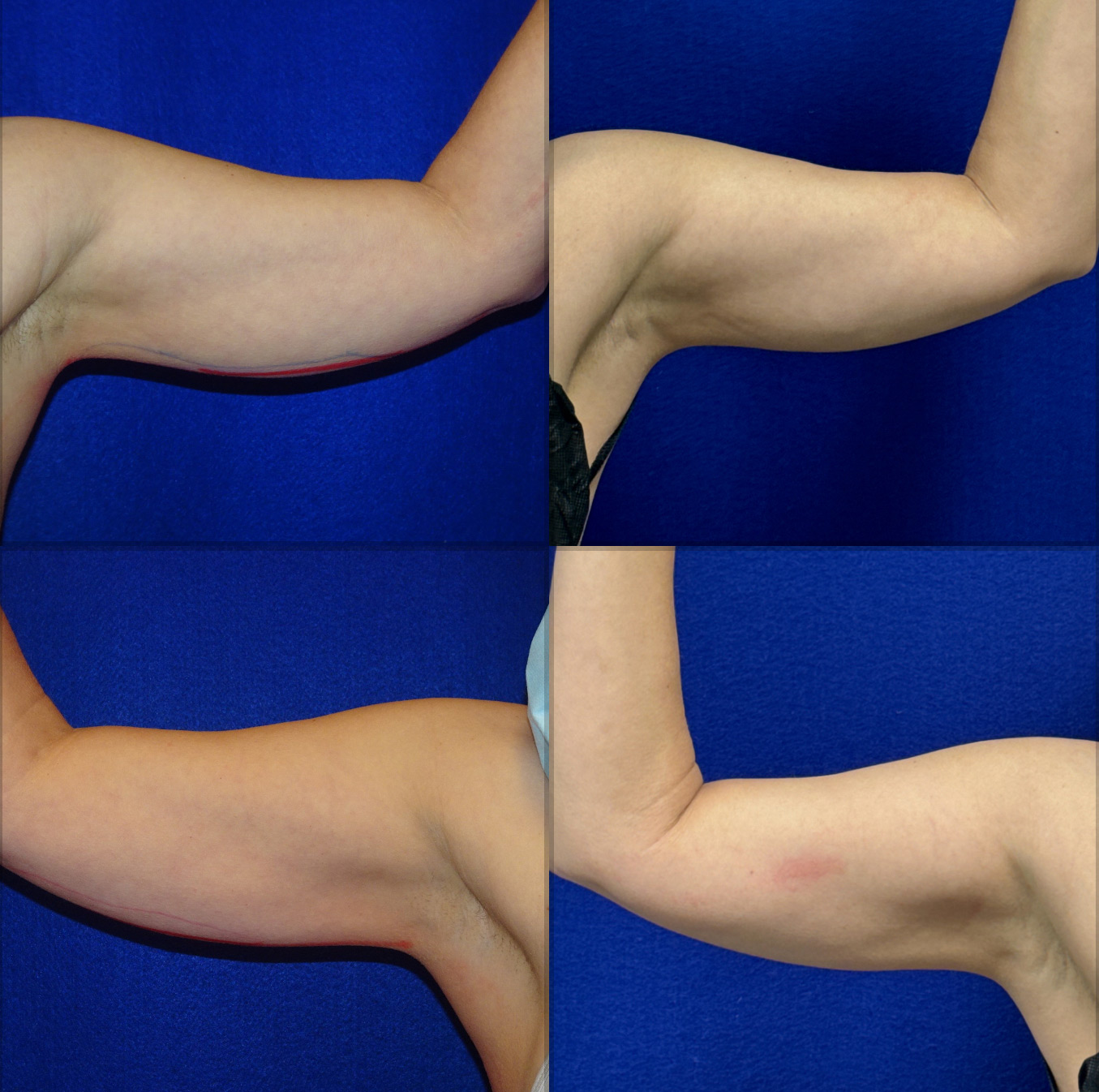 Picture of CoolSculpting-45