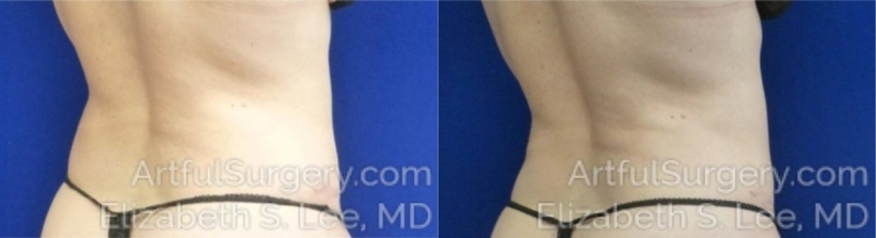 Picture of CoolSculpting-04A