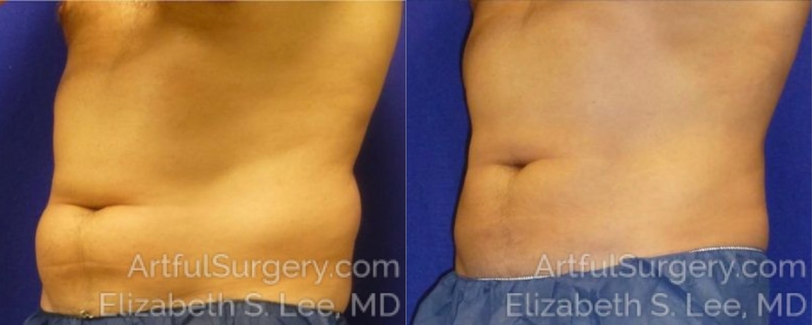 Picture of CoolSculpting-05a