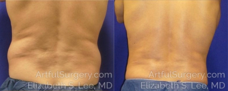 Picture of CoolSculpting-05b