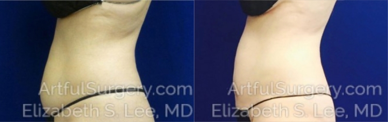 Picture of CoolSculpting-01