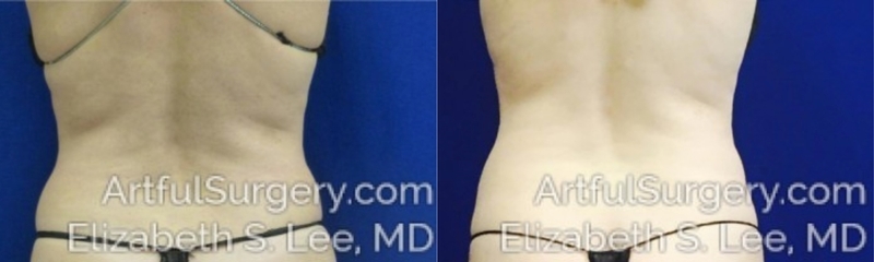 Picture of CoolSculpting-06A