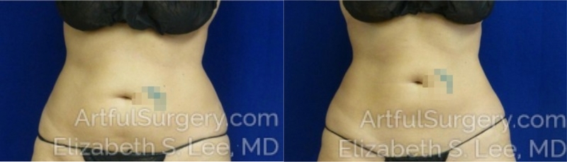 Picture of CoolSculpting-07A