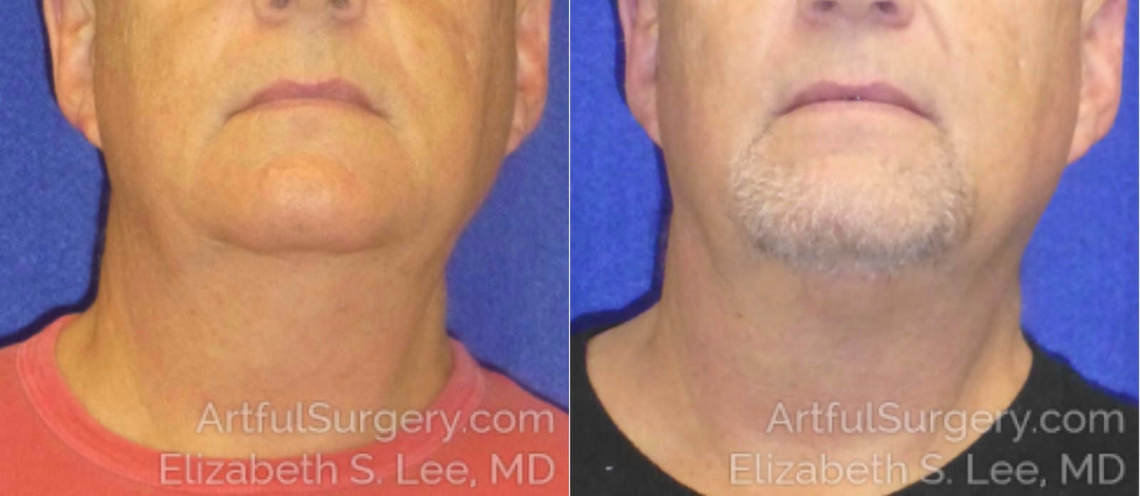 Picture of CoolSculpting-08