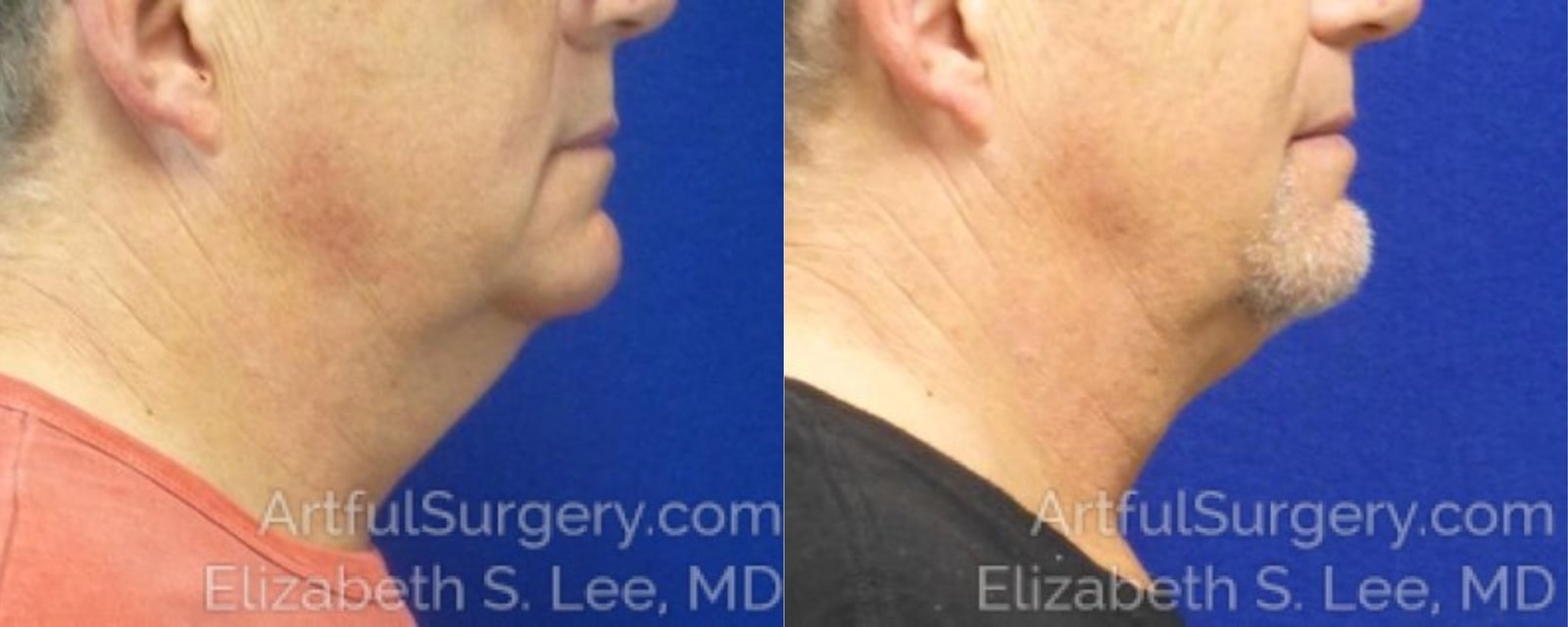 Picture of CoolSculpting-08a