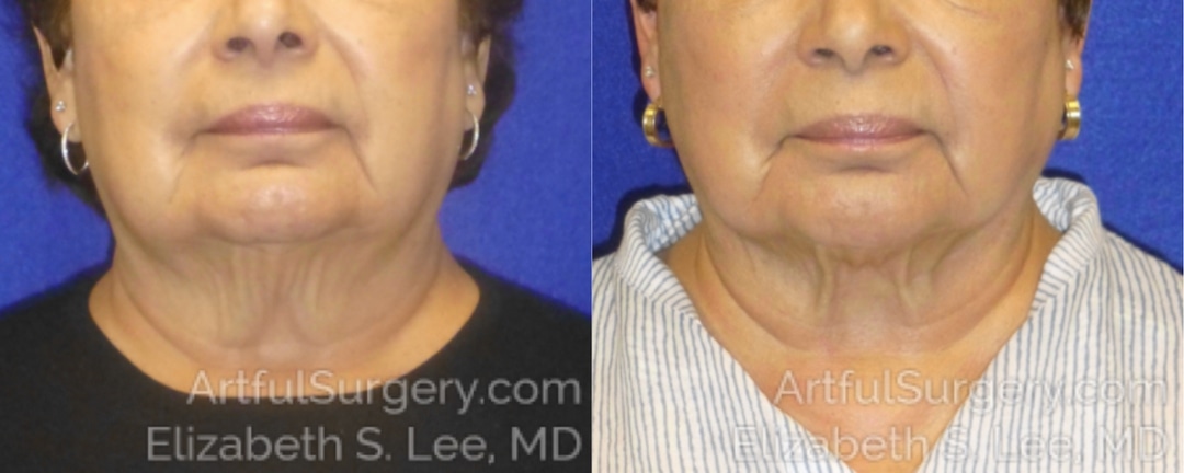 Picture of CoolSculpting-09