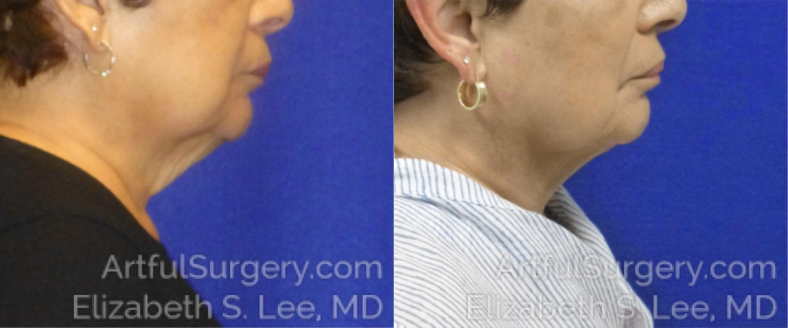 Picture of CoolSculpting-09a