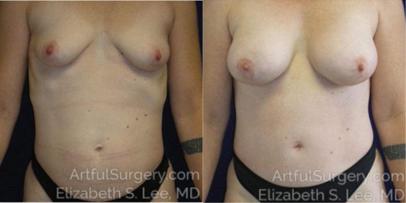 Picture of Mommy Makeover-01