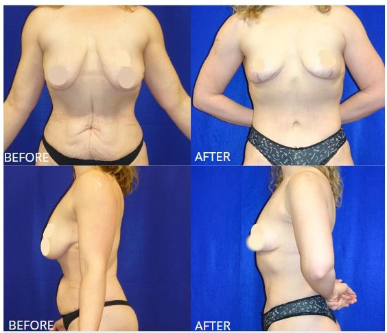 Picture of Mommy Makeover-10