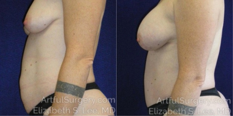 Picture of Mommy Makeover-01