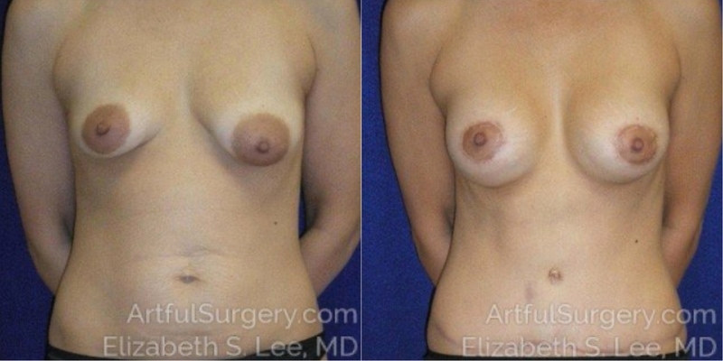 Picture of Mommy Makeover-02