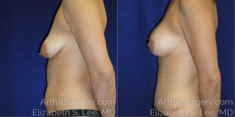 Picture of Mommy Makeover-02A