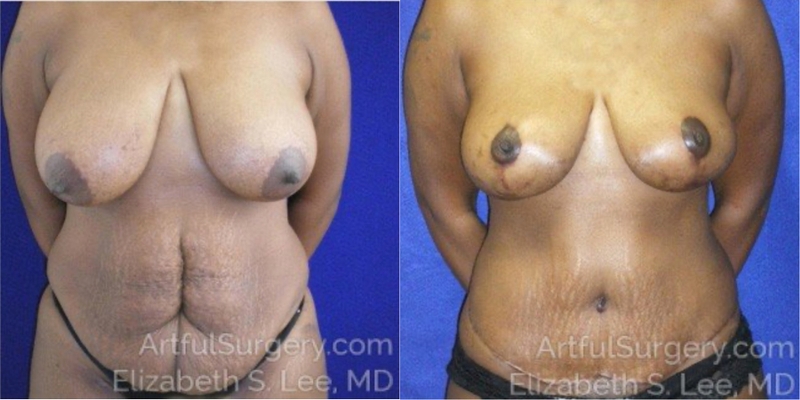 Picture of Mommy Makeover-03