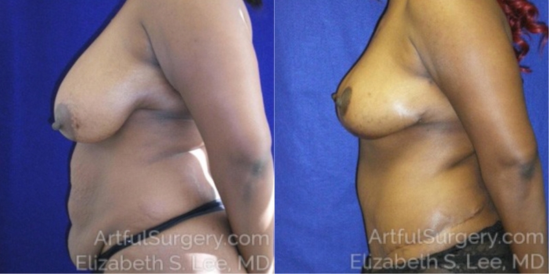 Picture of Mommy Makeover-03A