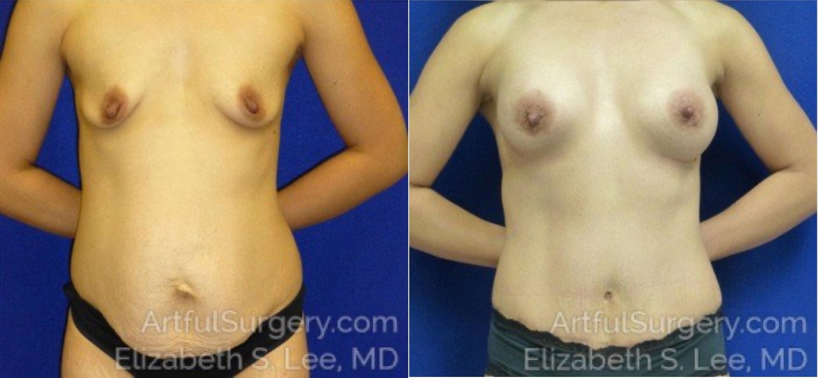 Picture of Mommy Makeover-04