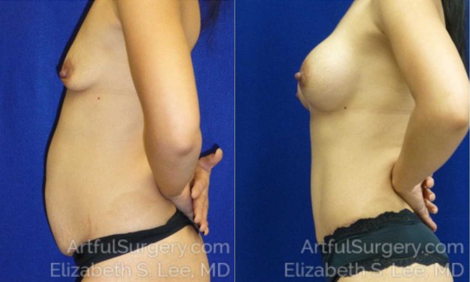 Picture of Mommy Makeover-04A