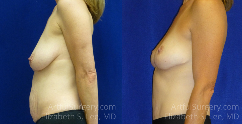 Picture of Mommy Makeover-05A