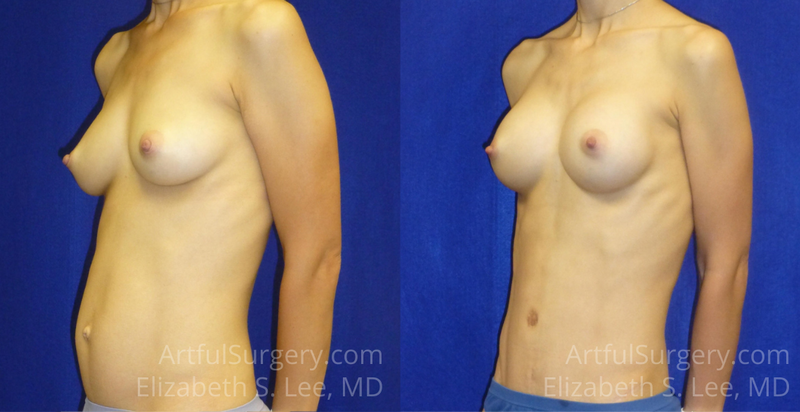 Picture of Mommy Makeover-06A