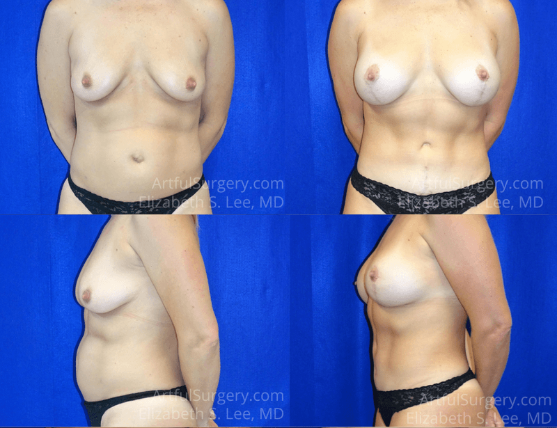 Picture of Mommy Makeover-07