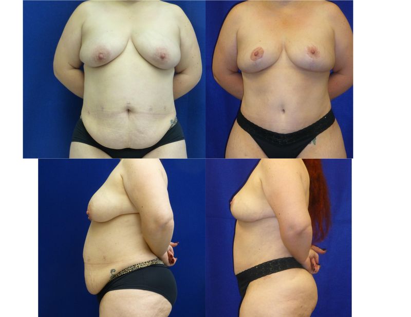 Picture of Mommy Makeover-08