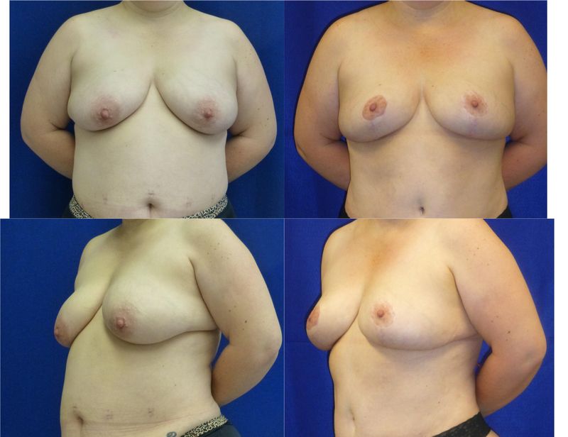 Picture of Mommy Makeover-08a