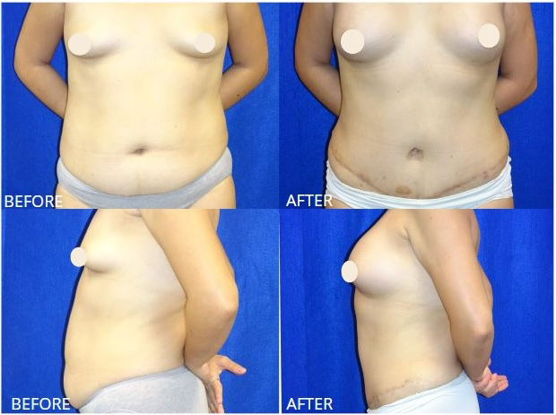 Picture of Mommy Makeover-09