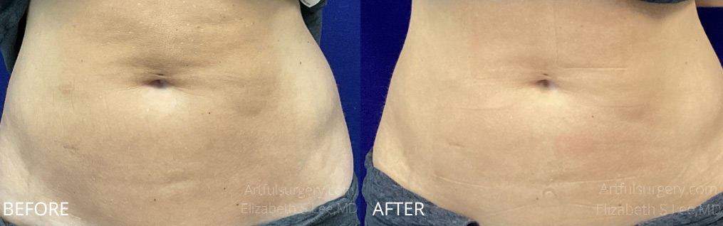 Picture of BodyTone - Abdomen
