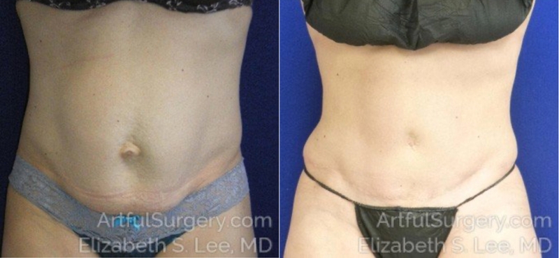 Picture of Tummy Tuck-10