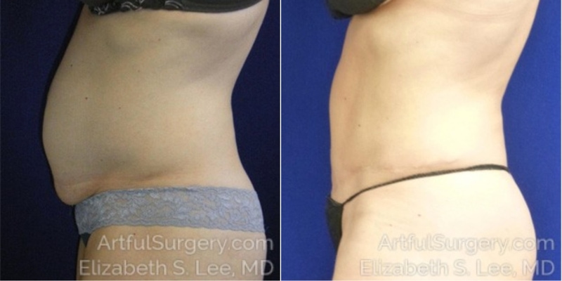 Picture of Tummy Tuck-10A