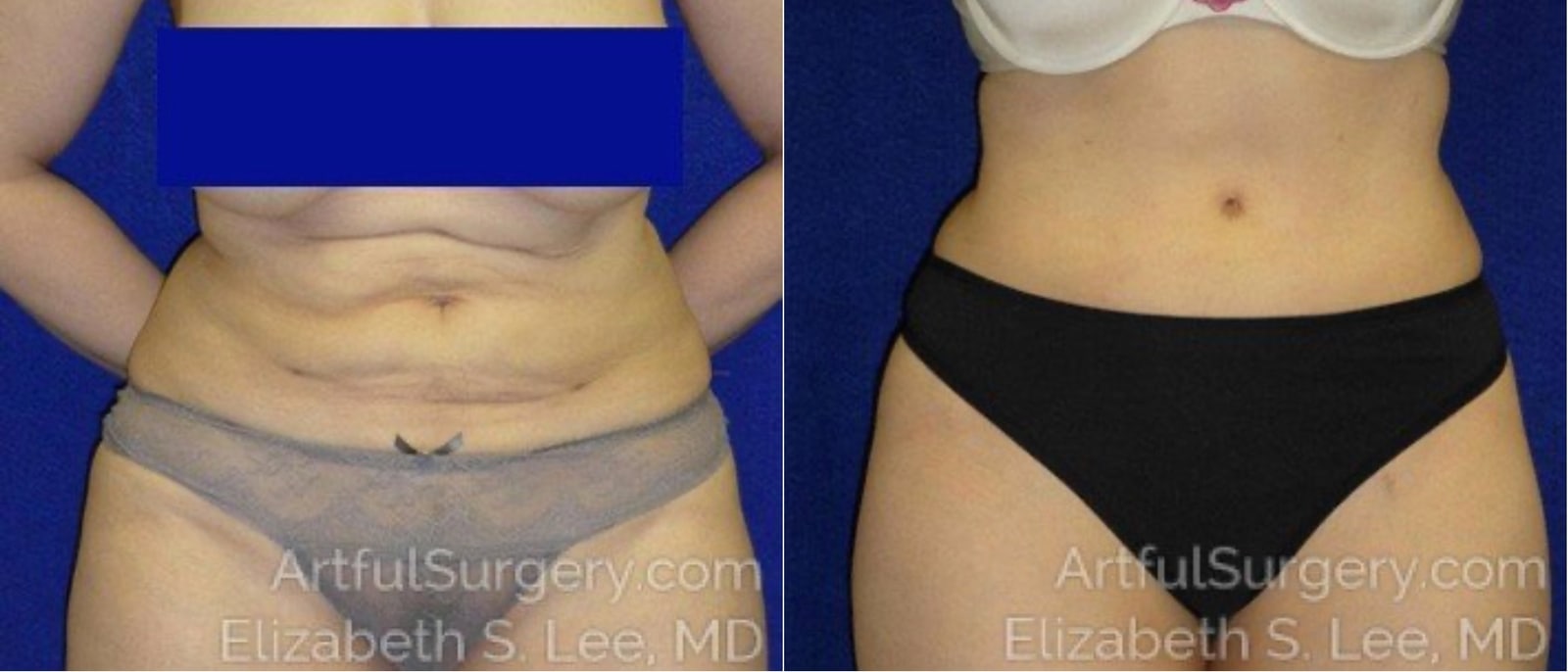 Picture of Tummy Tuck-11